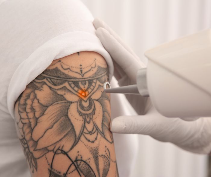 laserowe usuwanie tatuażu rzeszów